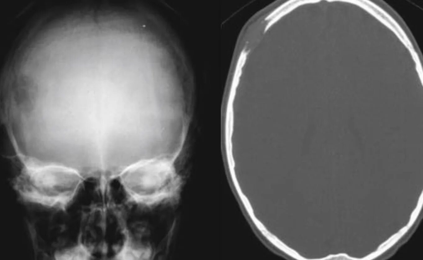 Образование кости черепа. Эозинофильная гранулема костей черепа. Эозинофильная гранулема лобной кости кт. Эозинофильная гранулема кости черепа кт. Эозинофильная гранулема рентген.