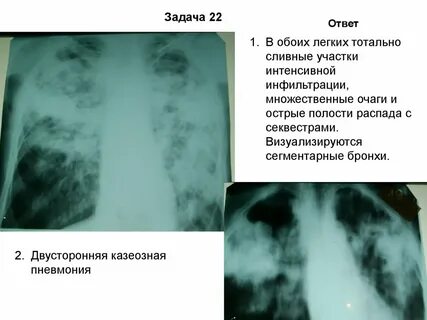 Обоих легких