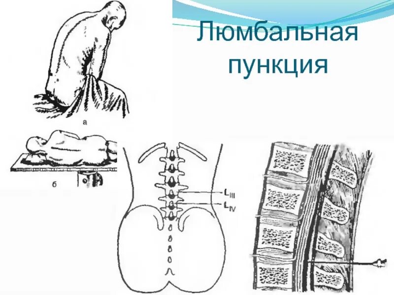 Проведение спинномозговой пункции