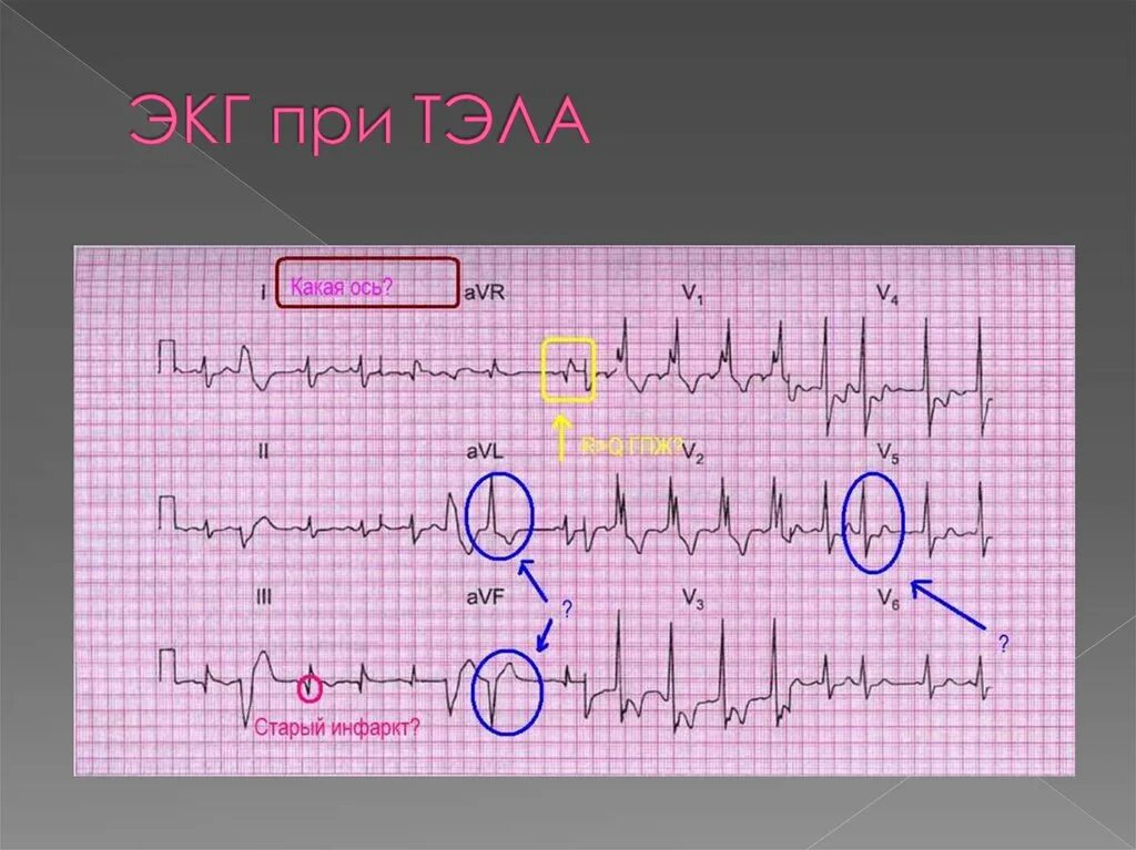 Тромбоэмболия легочной артерии экг. S1 q3 t3 на ЭКГ. Синдром s1 q3 на ЭКГ. ЭКГ при Тэла. ЭКГ при тромбоэмболии.