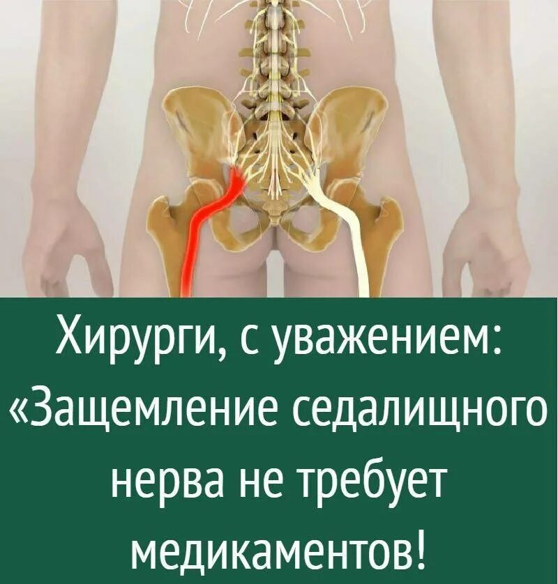 Защемление седалищный нерв симптомы и как лечить. Защемление седалищного нерва. защемление седалищного нерва симптомы. нерв в пояснице. защемление нерва в позвоночнике.