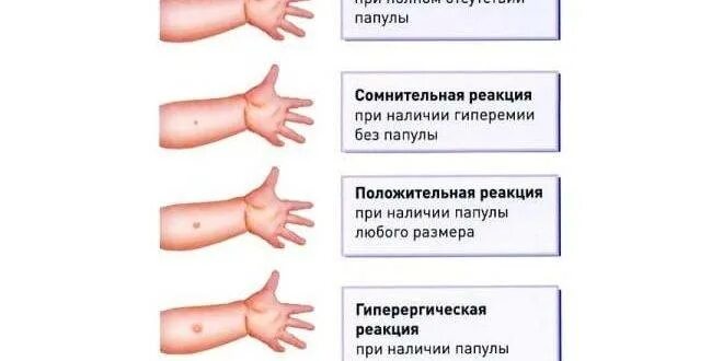 Можно ли мочить манту ребенку. Реакция манту норма у детей 2 года норма. реакция манту норма у детей 5-6.