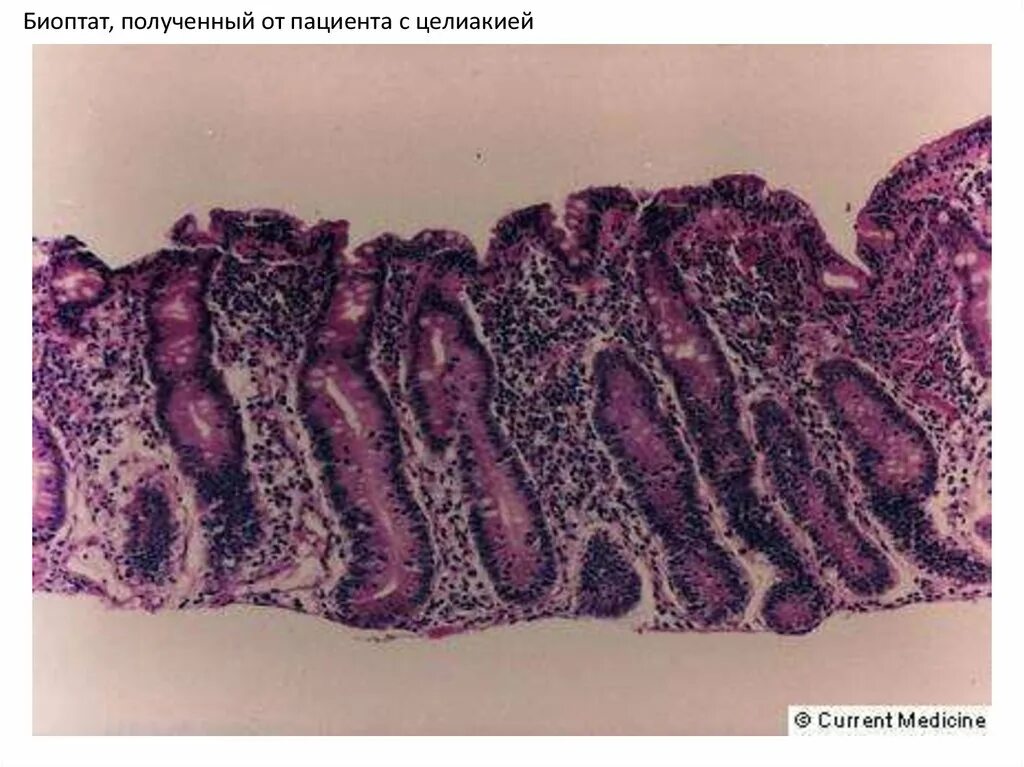Биоптат слизистой оболочки. Целиакия гистология кишечника. Целиакия микропрепарат.