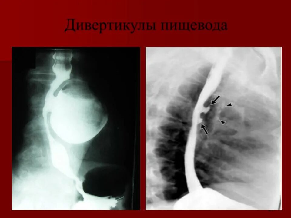 Дивертикул трахеи. Эпифренальные дивертикулы пищевода. дивертикул ценкера пищевода. дивертикул пищевода ценкера рентген.