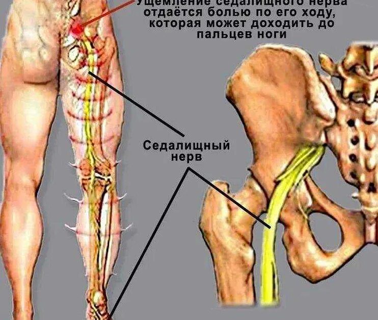 Как проявляется седалищный нерв симптомы. Пояснично седалищный нерв. зона иннервации седалищного нерва. седалищный нерв нейродикловит. защемило седалищный нерв.