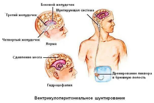 Шунт гидроцефалии схема. Шунт головной мозг ликвора. Гидроцефалия головного шунт. Шунт головного мозга при гидроцефалии.