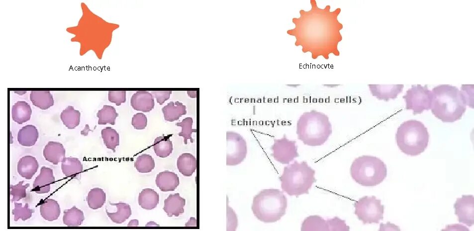 Эхиноциты. Шизоциты картинки. Эхиноцит картинки. Burr Cells.