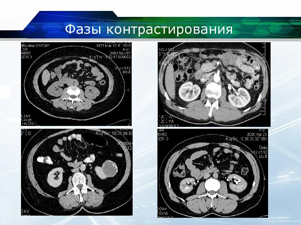 Фазы контрастирования почек на кт. Фазы контрастирования почек при кт. Портальная фаза контрастирования при кт. Отсроченная фаза контрастирования кт. Н 3 кт