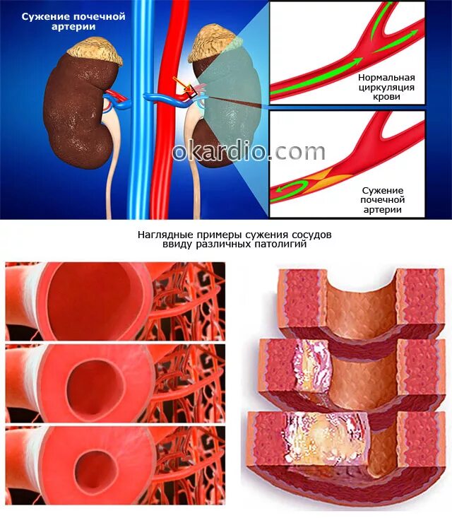 Сужение сосудов симптомы лечение. Фибромускулярная дисплазия почечной артерии. Фибромускулярная дисплазия почечных артерий клиника. Стеноз почечной артерии. Стеноз почечных сосудов.