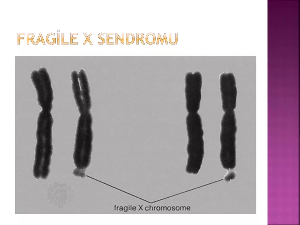 Отсутствие х хромосомы у мужчин. Синдрома фрагильной x-хромосомы. Синдром ломкой х-хромосомы.
