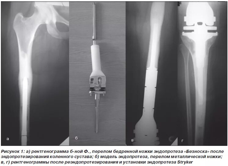 Осложнения после эндопротезирования тазобедренного. Эндопротез коленного сустава Stryker. Онкологический эндопротез тазобедренного сустава. Коленный модульный эндопротез Stryker. Периостит бедренной кости после эндопротезирования.