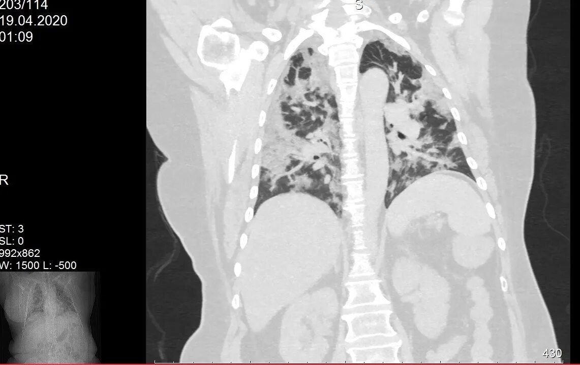 Поражение легких при коронавирусе. 100 Процентов поражения легких. 80 поражения легких