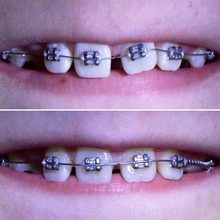 детская брекет система