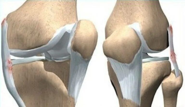Разрыв назад. Дисторсия тазобедренного сустава. Мениск тазобедренного сустава. Дисторсия коленного сустава. Перерастяжение связок коленного сустава.
