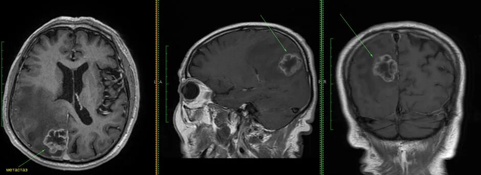 Кт после химиотерапии. Опухоли головного мозга MRT. Глиома затылочной доли. Опухоли головного мозга на кт с контрастированием. Опухоль головного мозга снимок мрт.
