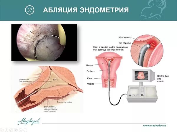 Аблация эндометрии