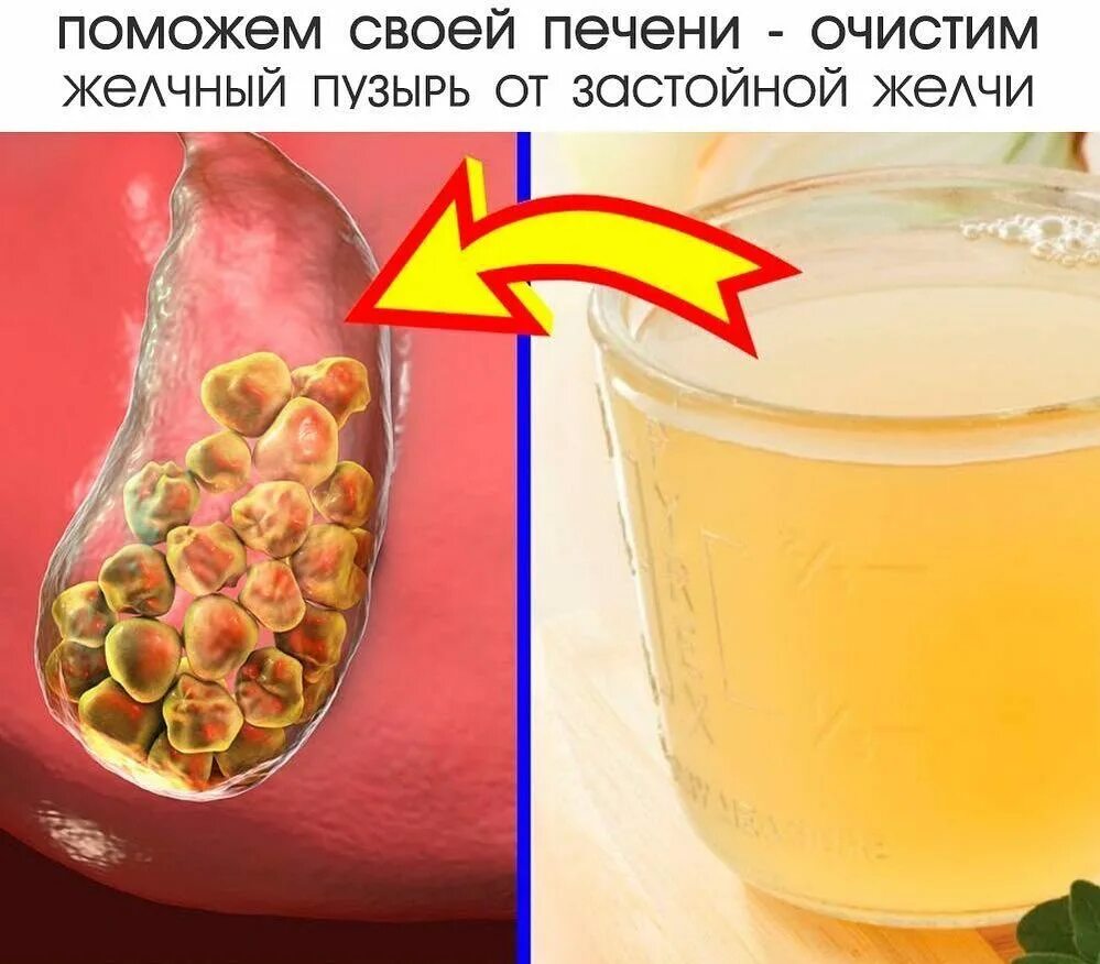 Сок для очищения желчного пузыря. Очищение печени и желчного пузыря. Лимон для желчного пузыря. Медовая вода от камней в желчном пузыре. Желчный пузырь как удалить желчь