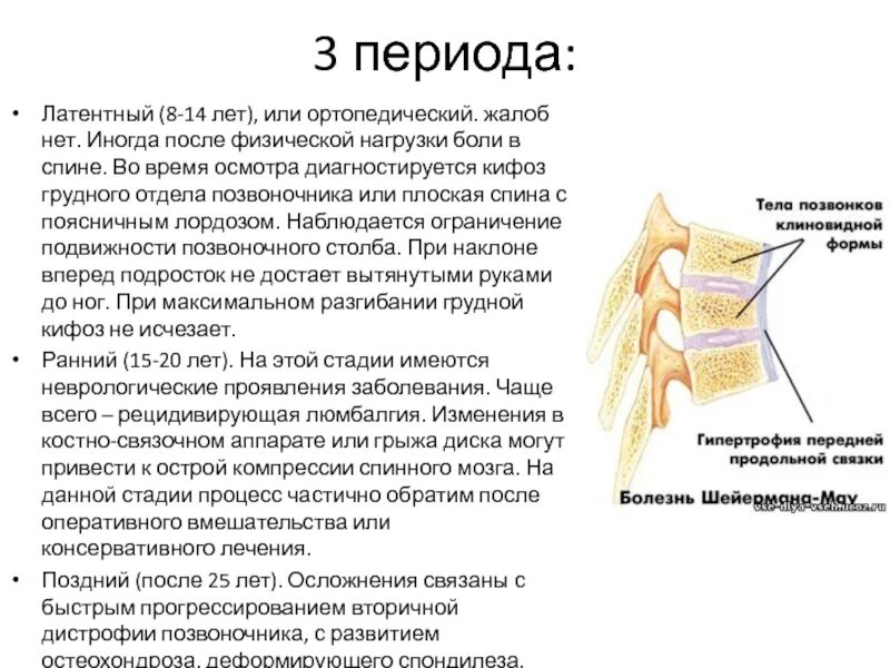 Болезнь шейермана мау что. Болезнь позвоночника шейермана-мау у подростков. остеохондропатия позвонков болезнь шейермана-мау. болезнь шейермана мау грудного отдела позвоночника. шерман мау заболевание позвоночника.