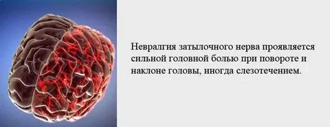 Невралгия мозга