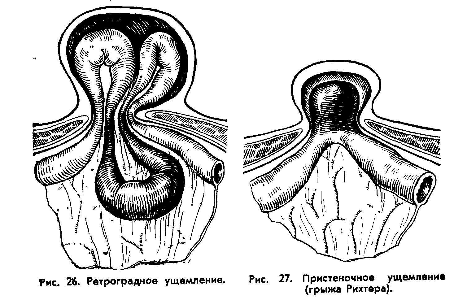 Ущемленная брюшной грыжа. Пристеночное ущемление (грыжа Рихтера). Рихтеровского ущемления грыжи. Ретроградное ущемление грыжи. Каловая ущемленная грыжа.