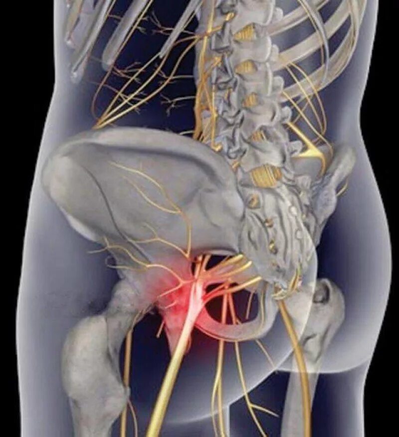 Люмбоишиалгия седалищного нерва. Остеохондроз люмбоишиалгия. Вертеброгенная люмбоишиалгия позвоночника. Нерв в правой ягодице