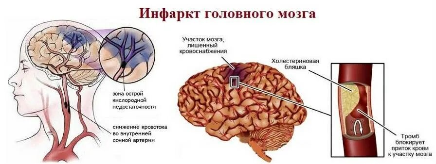 Тромбы после инсульта