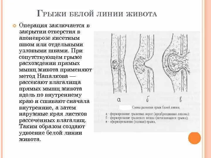 Карта вызова ущемленная грыжа. Грыжи грыжа белой линии живота. Грыжи белой линии живота. Механизм образования.. Грыжа белой линии живота у детей этапы операций. Белая линия живота при пупочной грыже.