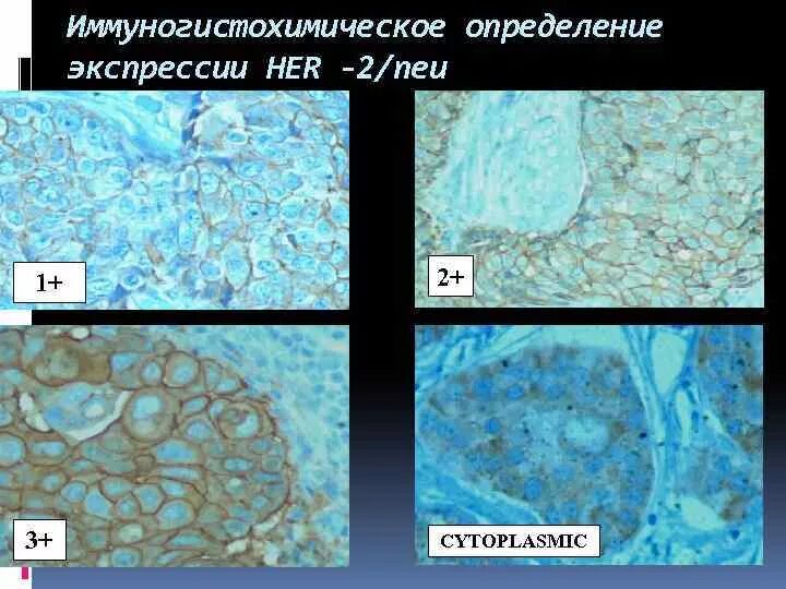 Иммуногистохимическое исследование. Метод ИГХ. Иммуногистохимический метод исследования. Иммуногистохимическое окрашивание. Иммуногистохимические маркеры