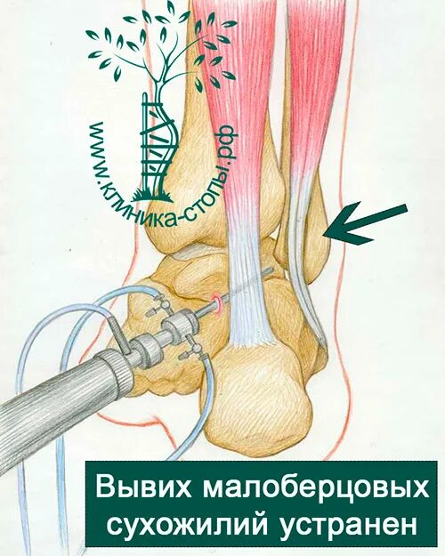 Растяжение связок сухожилий