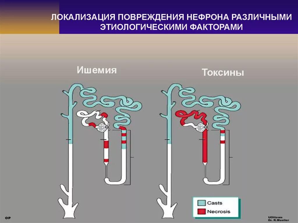 Нефрона почек патфиз. Юкстамедулярный нефроны. Строение нефрона. Поврежденный нефрон. Что образуется в нефроне