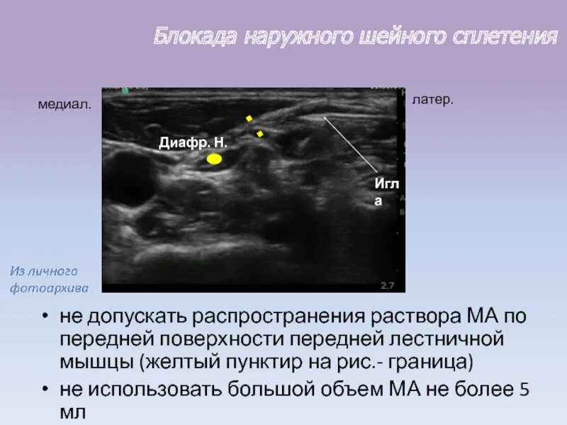 Блокада под узи. УЗИ плечевого сплетения. Блокада шейного сплетения. Блокада наружного шейного сплетения. Блокада шейного сплетения под УЗИ.