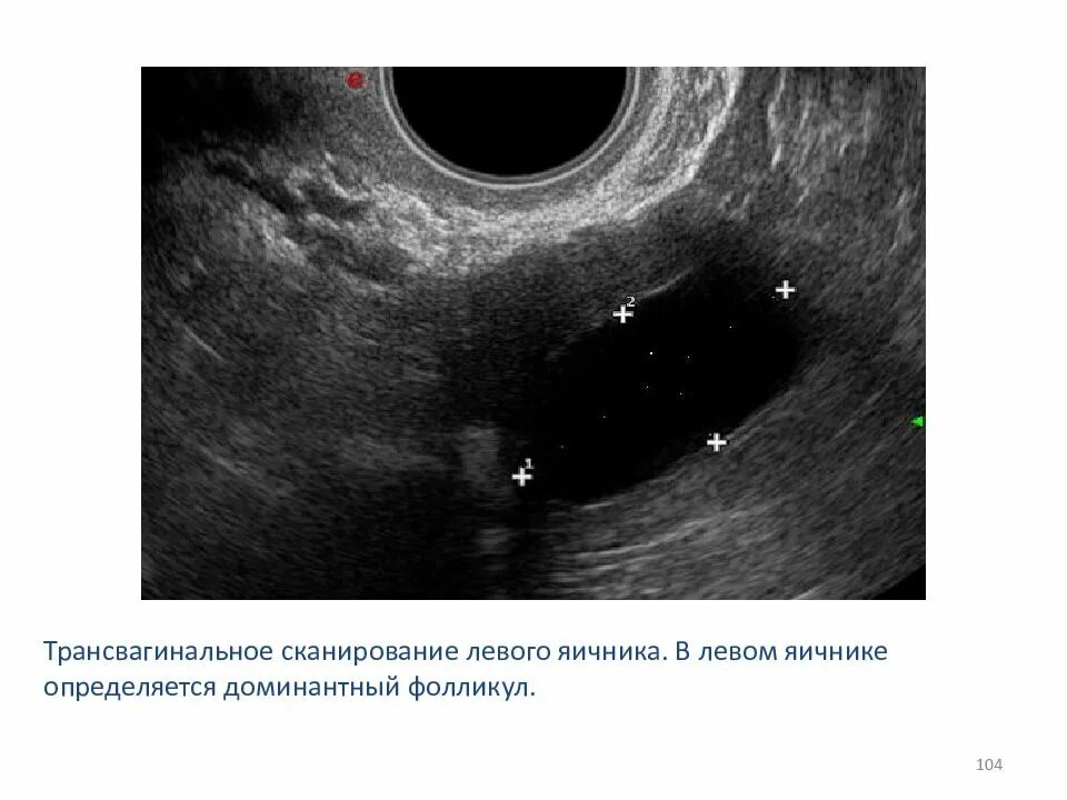 УЗИ яичников доминантный фолликул. Яичник с доминантным фолликулом по УЗИ. Левый яичник в структуре доминантный фолликул. Доминантный фолликул УЗИ признаки. Три фолликула