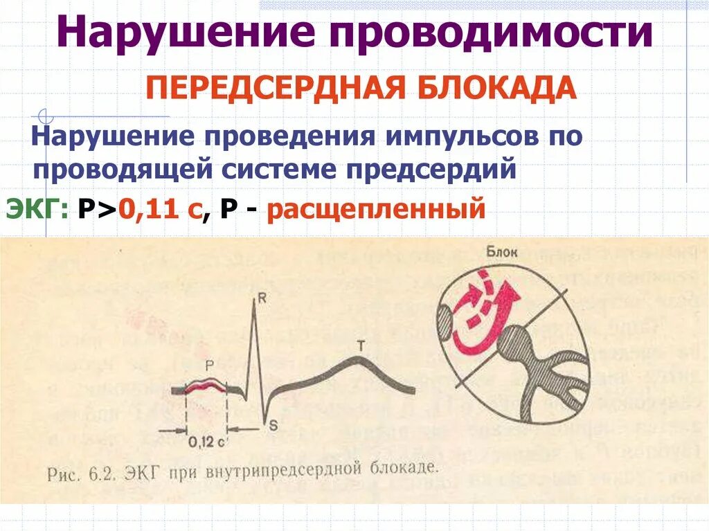 Нарушение лж проводимости. Нарушение проводимости сердца на экг. экг критерии нарушения проводимости. нарушение проводимости блокады экг. экг при нарушении желудочковой проводимости.