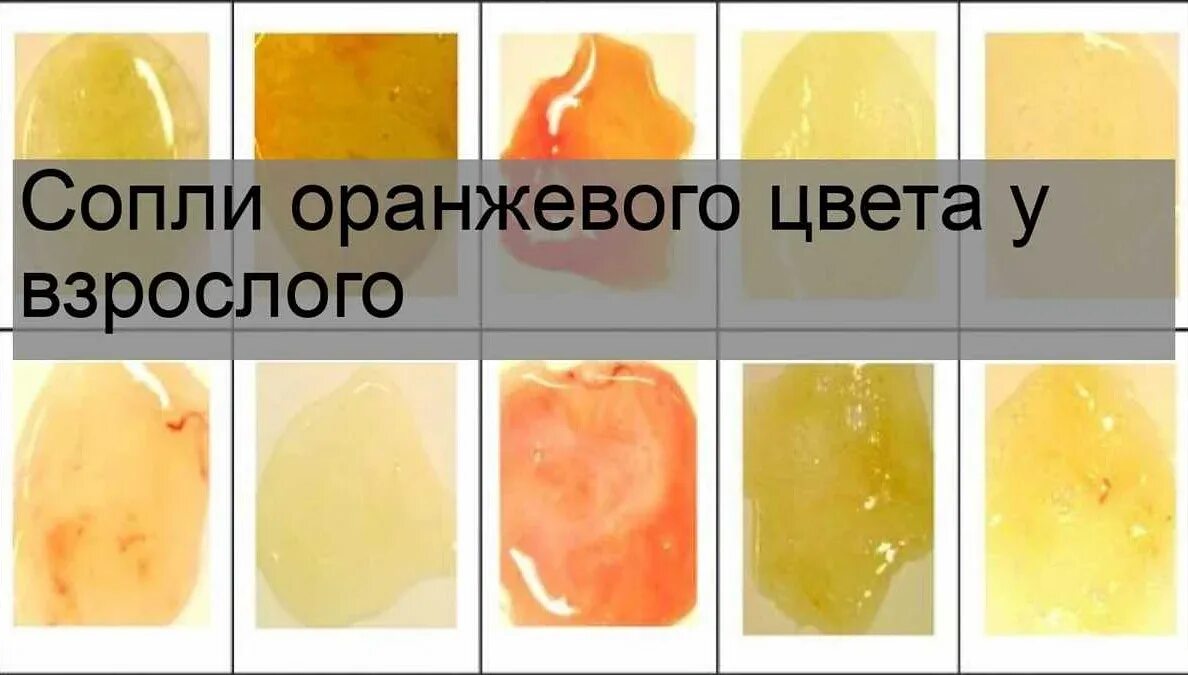 Желтая мокрота температура
