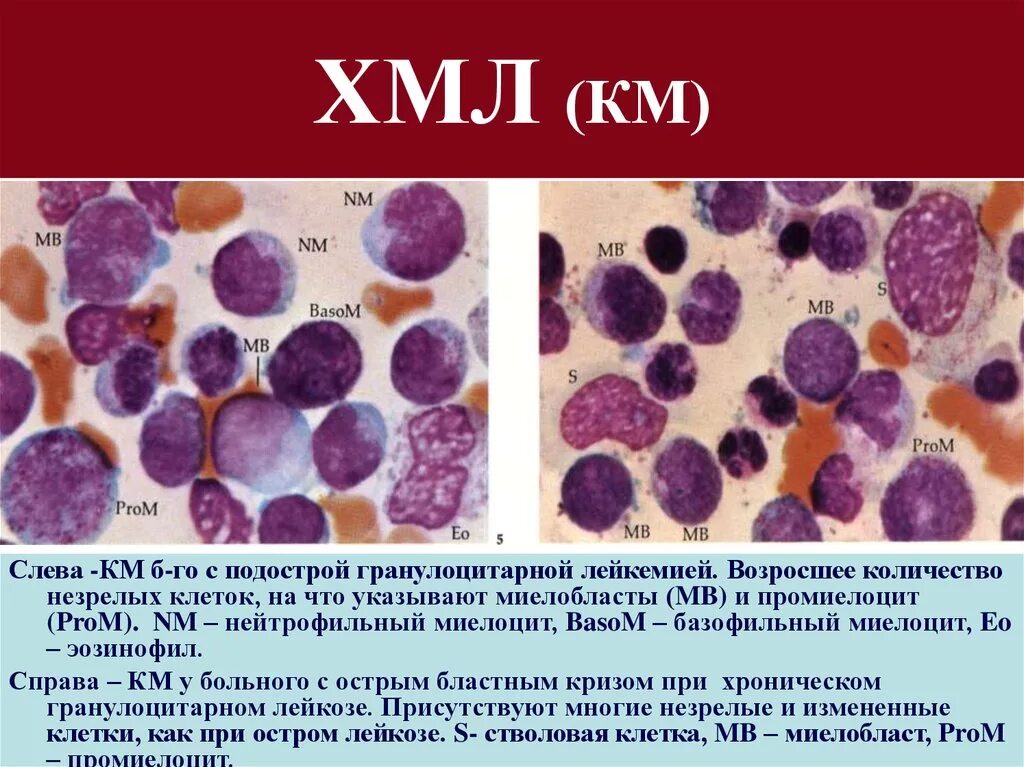 ХМЛ – хронический миелобластный лейкоз. Хронический миелолейкоз гистология. Хронический миелолейкоз картина крови. Хронический миелоцитарный лейкоз (ХМЛ).