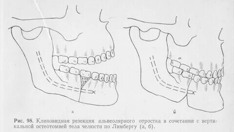 Частичная область
