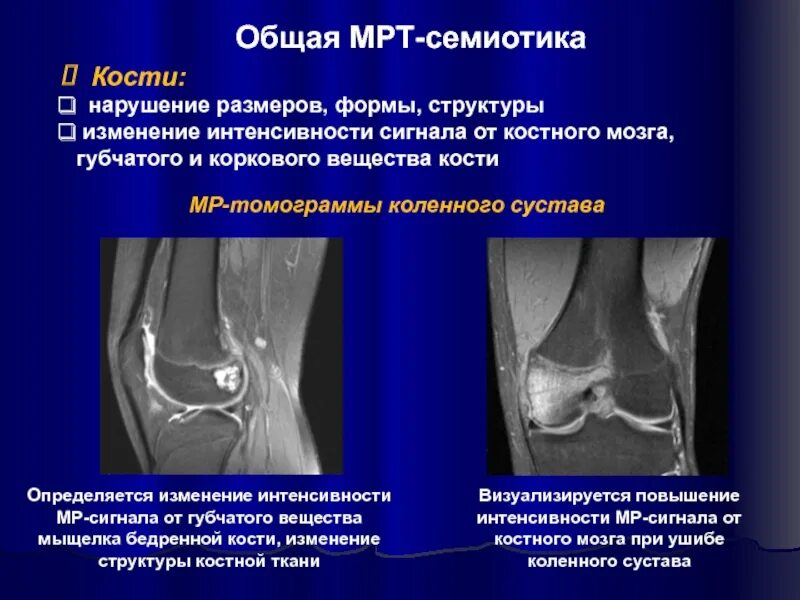 Повреждение мыщелка. Остеонекроз коленного сустава мрт. Отек костного мозга коленного сустава на мрт. Инфаркт костного мозга мыщелка бедренной кости.