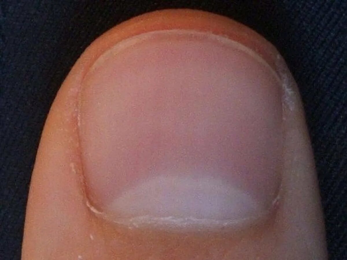 белые точки на ногтях что это