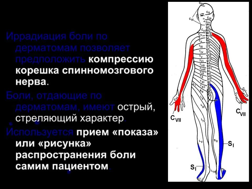 Синдром компрессии корешка s1. Синдром компрессии s1 корешка справа. Компрессии корешка l5 или s1. Иррадиация боли.