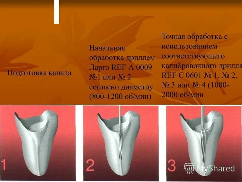 Обработка и пломбирование корневых каналов