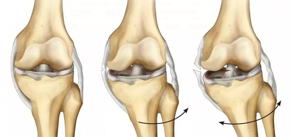 Артроз коленного сустава мениск. Задняя крестообразная связка коленного сустава анатомия. Разрыв капсульно связочного аппарата. Разрыв связок ПКС коленного сустава. Разрыв крестообразной связки сустава колена.