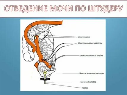Операция мочевого пузыря трубка