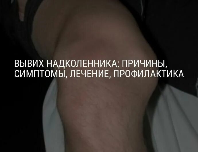 Вывих коленной чашечки у человека. Диспластический вывих надколенника. торсионный вывих надколенника. вправившийся вывих надколенника. вывих надколенника и коленного сустава.