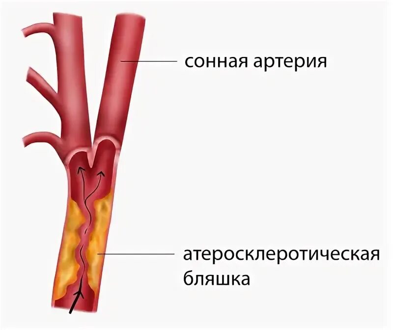 Атеросклероз сосудов сонных артерий. Холестериновая бляшка в сонной артерии.