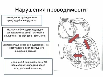 Нарушение проводящей системы