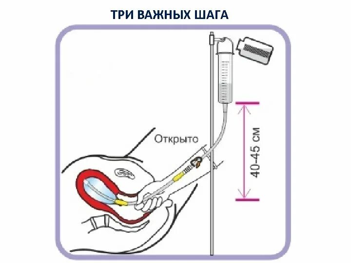 Катетер маточный баллонный. Двухбаллонный катетер жуковского. Баллонная маточная тампонада жуковского. Баллонная тампонада- катетер бакри. Катетер маточный двухбаллонный жуковского.