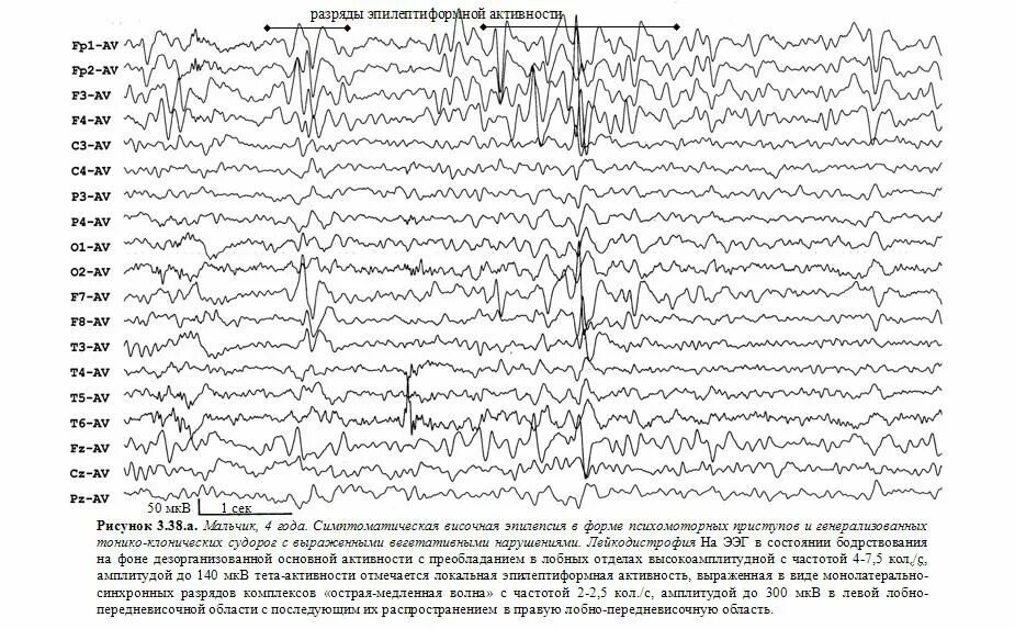 Ээг по омс. Эпилептиформные разряды на ЭЭГ. Гипсаритмия паттерны на ЭЭГ. Эпилептиформные разряды на ЭЭГ У ребёнка.