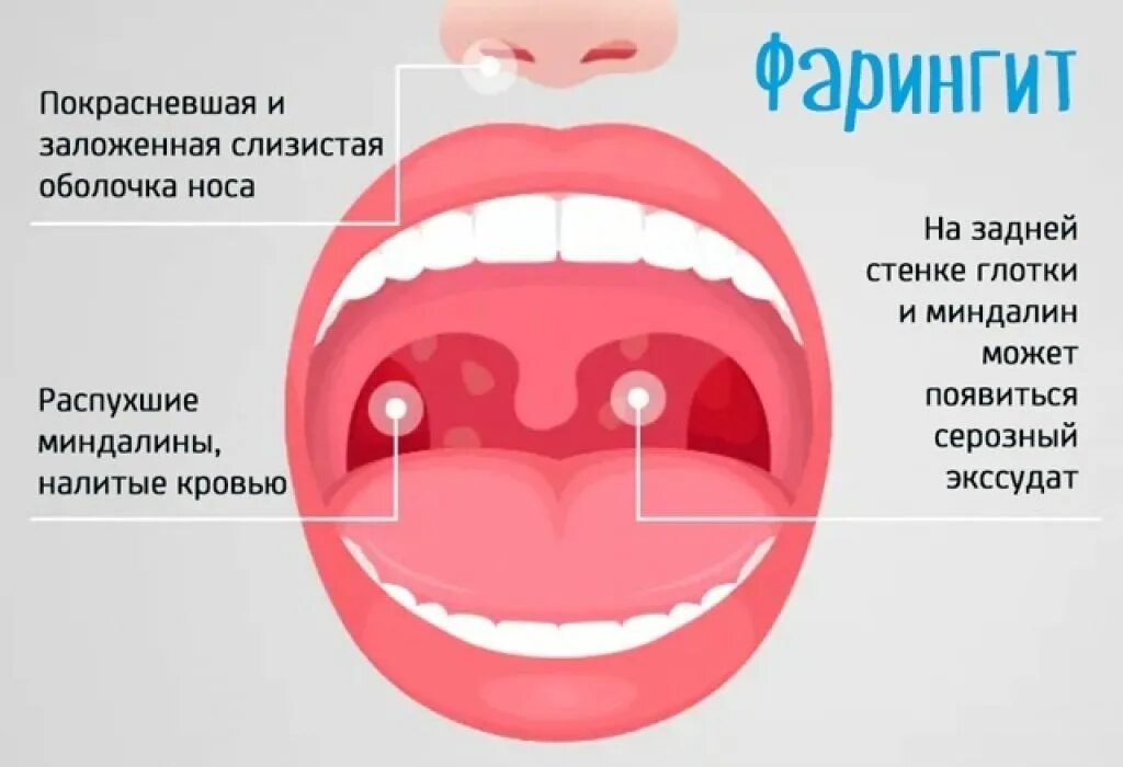 Герпесвирусная ангина. Вид зева