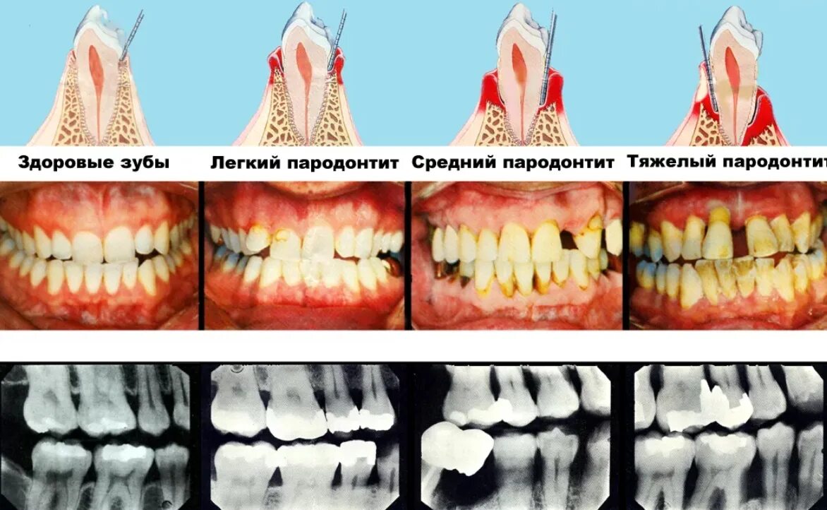 Можно ли есть зубы. Быстропрогрессирующий пародонтит. Язвенно некротический гингивит. Язвенно-некротический гингивит-пародонтит. Некротизирующий гингивит.