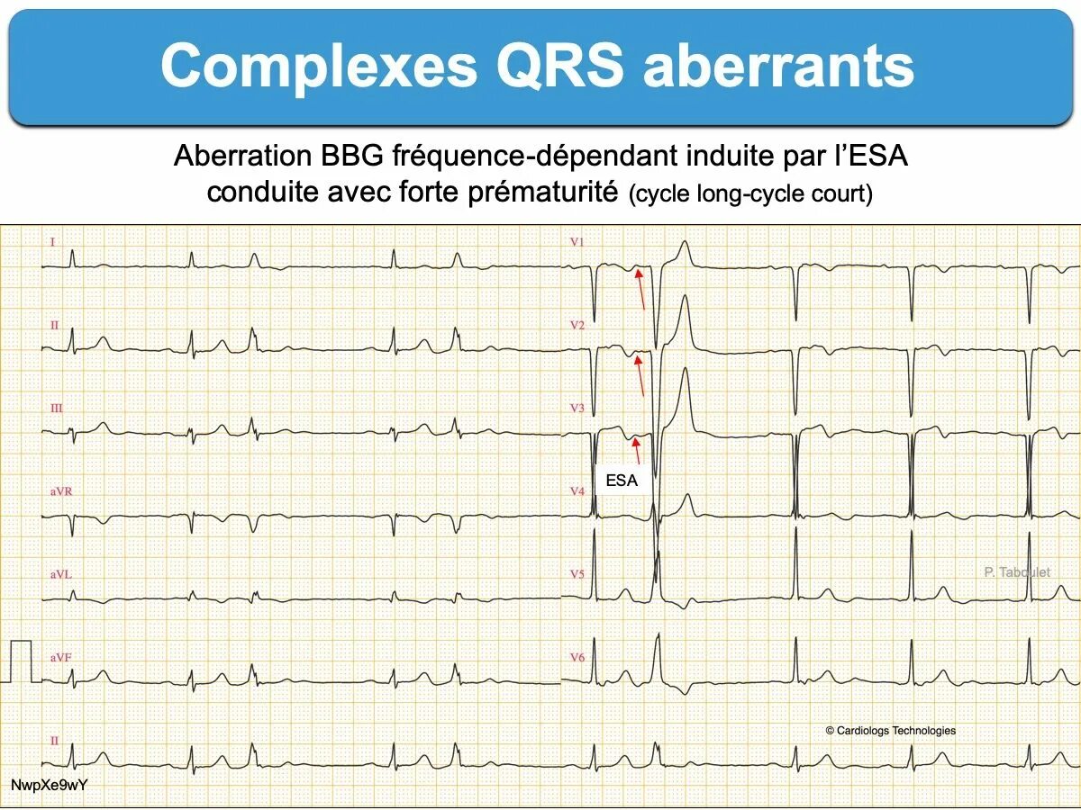 Широкий комплекс QRS на ЭКГ. Комплекс QRS В v1 типа RSR’. Узкий комплекс QRS на ЭКГ. Расширение комплекса QRS В v1.